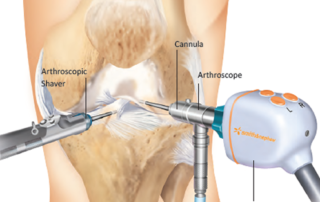 Knee Arthroscopy