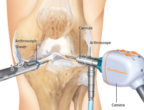 best knee arthroscopy in bhopal