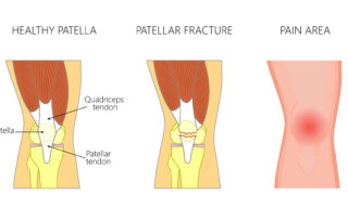 Knee Fracture