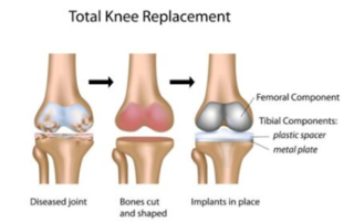 Knee Replacement