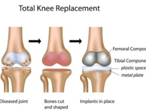 best knee replacement surgeon in balaghat