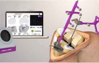 Navigation Based Joint Replacement Surgeries