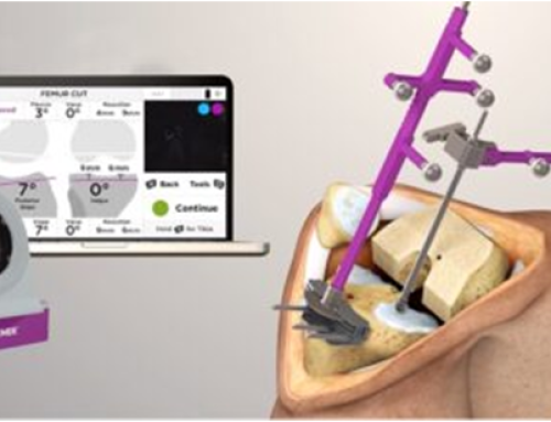 Navigation Based Joint Replacement Surgeries in chhindwara