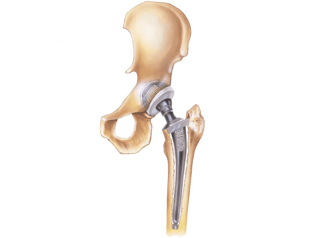 Best Hip Replacement in Nagpur