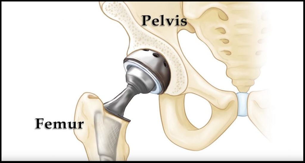 Hip Replacement